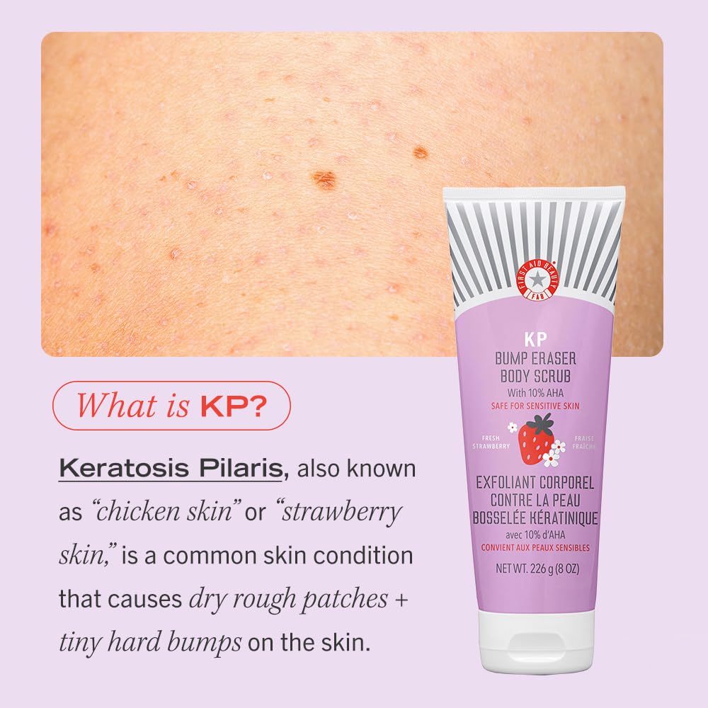 First Aid Beauty - KP Bump Eraser Body Scrub with 10% AHA, Keratosis Pilaris Exfoliator with Glycolic and Lactic acids, Helps Reduce Chicken Skin Bumps, Safe for Sensitive Skin, Strawberry Scent, 8 oz