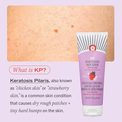 First Aid Beauty - KP Bump Eraser Body Scrub with 10% AHA, Keratosis Pilaris Exfoliator with Glycolic and Lactic acids, Helps Reduce Chicken Skin Bumps, Safe for Sensitive Skin, Strawberry Scent, 8 oz