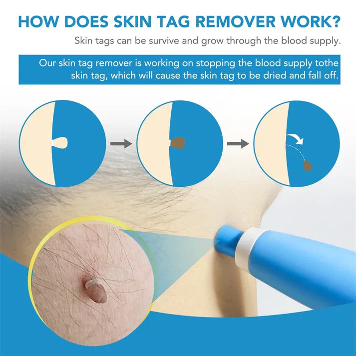 2-in-1 Skin Tag & Mole Remover Kit – Automatic Micro Removal Device for Face & Body